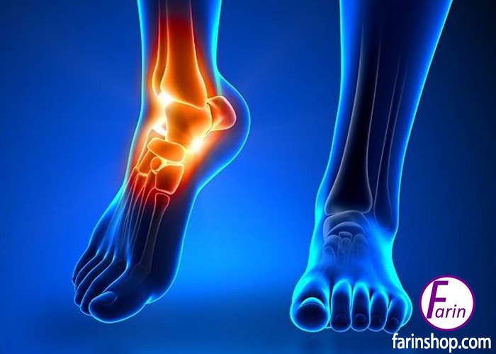 وجود استخوان اضافه یکی از علل درد قوزک پا